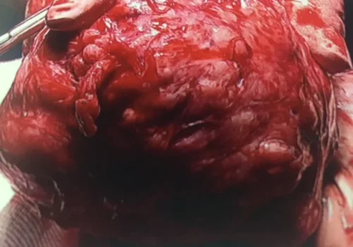 View of the open procedure. The uterus and fibroid are exteriorised. The fibroid is shelled out of the uterus. The uterus is then reconstructed. The pathology revealed a benign fibroid.