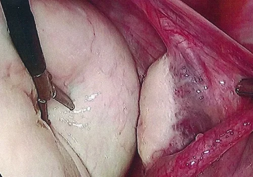 normal right ovary seen next to large left ovarian cyst