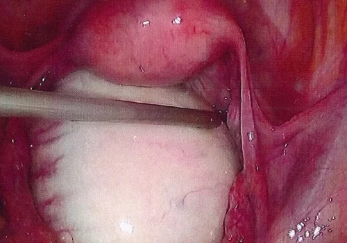 uterus seen above large left ovarian cyst